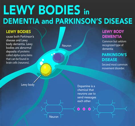 dlb lewy body dementia.